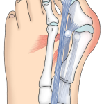 Hallux_valgus